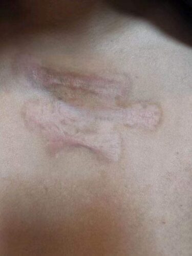 Gel para Cicatrizes e Estrias - Gel Scar photo review